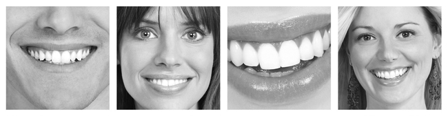 Invisalign Before and After Pictures